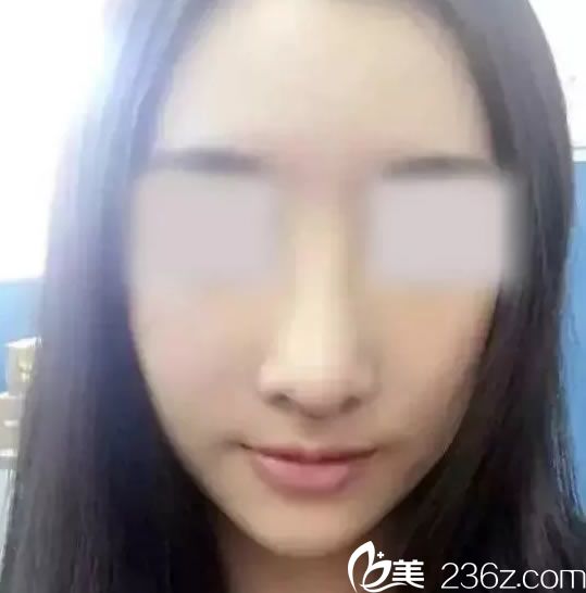 鼻综合整形手术7天拆线<span style= 鼻综合整形手术7天拆线<span style=