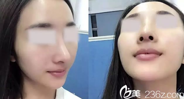 找徐建国做鼻子手术15天<span style= 找徐建国做鼻子手术15天<span style=