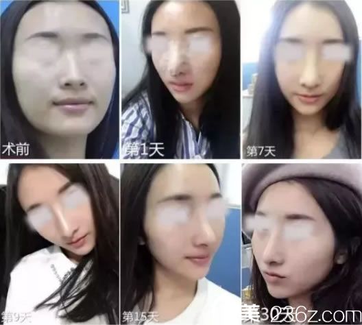 妹子在建国整形做鼻子恢复过程图 妹子在建国整形做鼻子恢复过程图