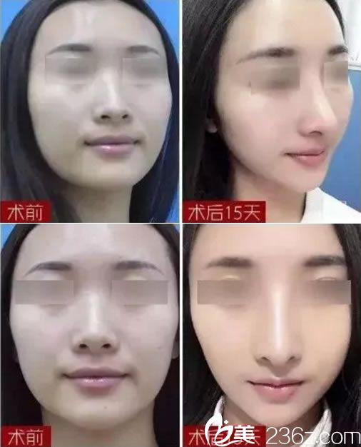 徐建国做鼻综合15天前后<span style= 徐建国做鼻综合15天前后<span style=