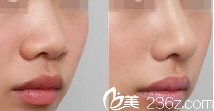 韩国yes整形外科医院真人案例图1 韩国yes整形外科医院真人案例图1