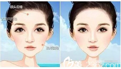 驻马店美林苑面部填充 驻马店美林苑面部填充