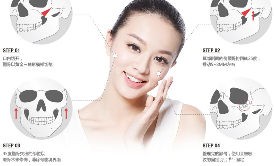 黄金三角形切骨和25度回转术