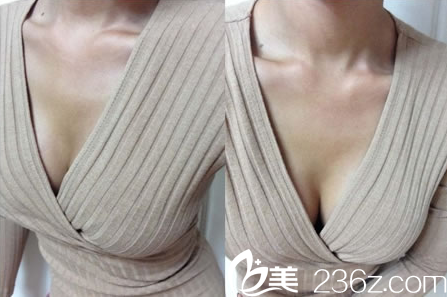 崔圭镇院长隆胸对比图