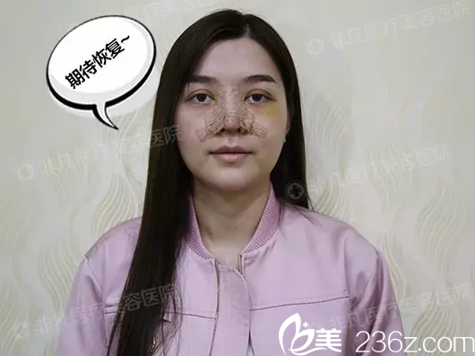 找深圳非凡梅够明院长做完隆鼻即刻效果