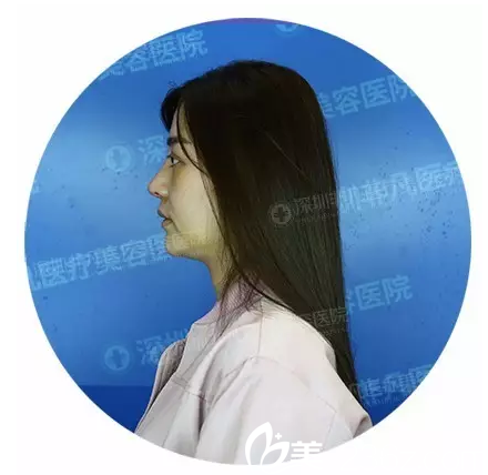 刚在深圳非凡做完鼻部拆线