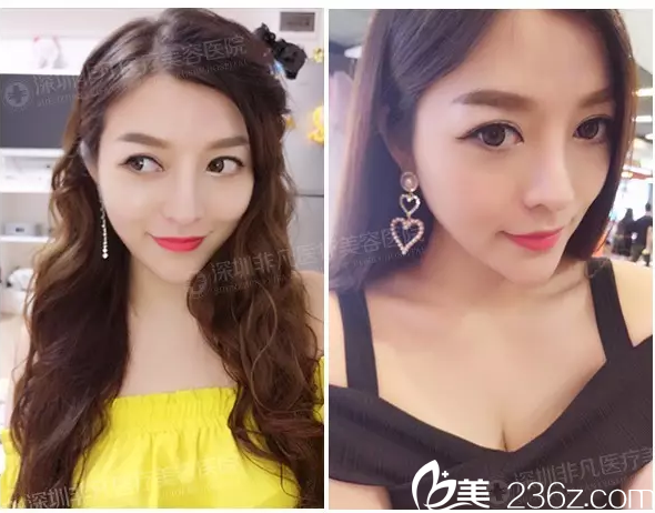 隆鼻术后1个月自拍