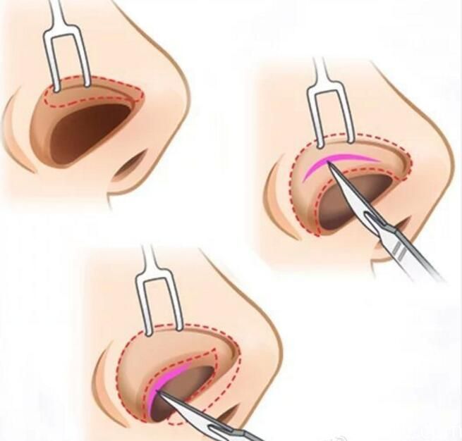非切开式隆鼻手术封闭式隆鼻方法 非切开式隆鼻手术封闭式隆鼻方法