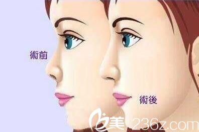 韩国格林整形医院自体脂肪隆鼻