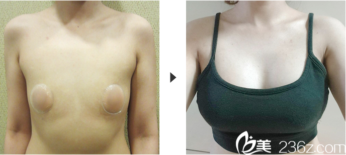世大特医院胸部整形案例术前术后对比照
