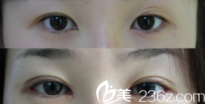 La Foret整形外科案例 La Foret整形外科案例