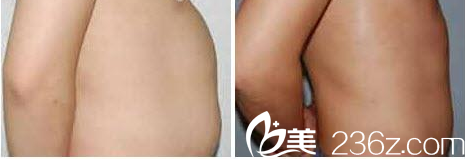 La Foret整形外科案例 La Foret整形外科案例