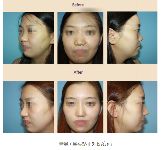 韩国眼鼻美人整形外科鼻部整形案例