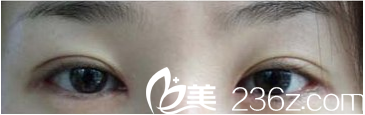 看我在La Foret整形外科做的双眼皮修复，李斗阳院长案例