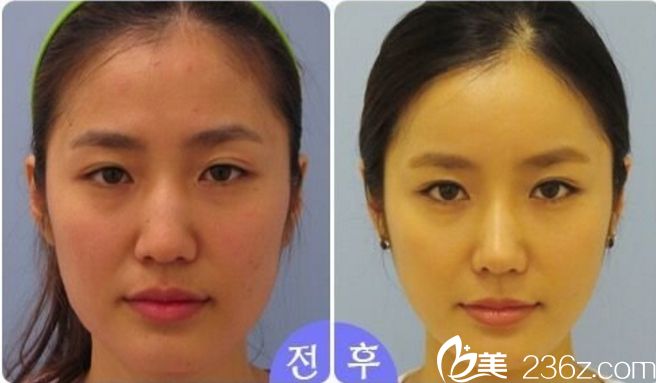 韩国美自人整形医院金灿棕院长做鼻子什么风格? 韩国美自人整形医院金灿棕院长做鼻子什么风格?