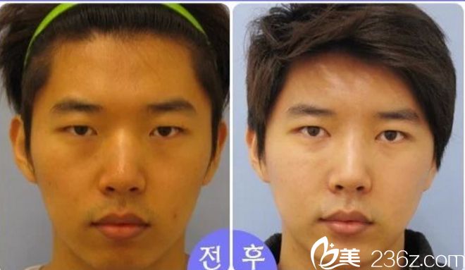 韩国美自人整形金灿棕院长非切开式隆鼻手术自然又不失时尚