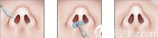 封闭式隆鼻方法 封闭式隆鼻方法