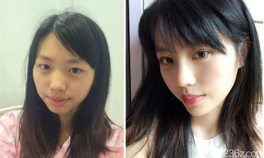 韩国美自人整形医院鼻整形真人案例 韩国美自人整形医院鼻整形真人案例