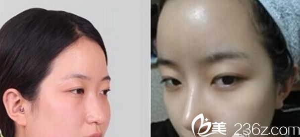 韩国美自人整形医院金灿棕院长做鼻子真人案例 韩国美自人整形医院金灿棕院长做鼻子真人案例