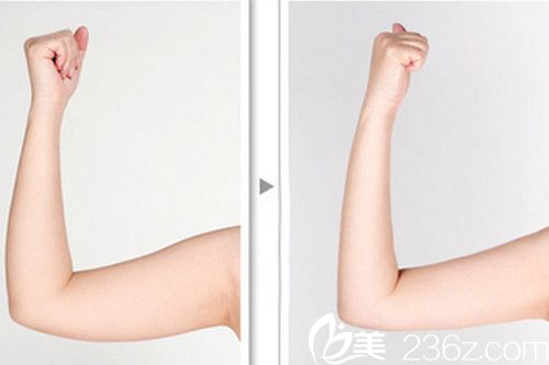 韩国眼鼻美人整形外科手臂吸脂对比