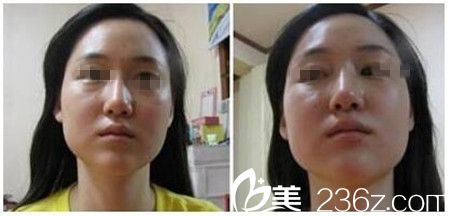 驻马店美林苑改脸型案例 驻马店美林苑改脸型案例