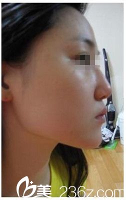 驻马店美林苑改脸型术前侧面照 驻马店美林苑改脸型术前侧面照