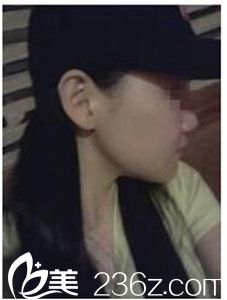 驻马店美林苑改脸型术后照 驻马店美林苑改脸型术后照