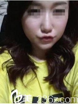 驻马店美林苑改脸型术后9周照 驻马店美林苑改脸型术后9周照