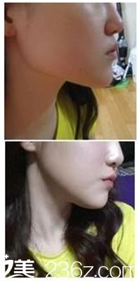 驻马店美林苑改脸型术后10周照 驻马店美林苑改脸型术后10周照