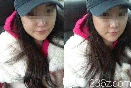 驻马店美林苑改脸型术后 驻马店美林苑改脸型术后