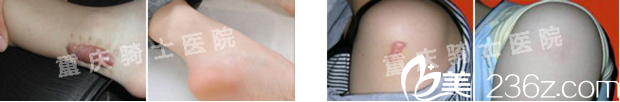 重庆骑士医院疤痕修复科祛疤真人案例