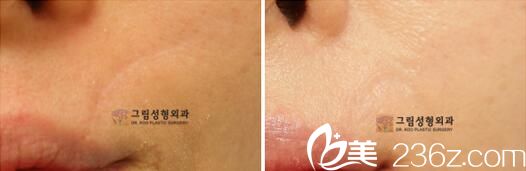 韩国格林整形医院真人案例1 韩国格林整形医院真人案例1