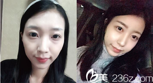 徐东皖院长面部自体脂肪填充案例对比 徐东皖院长面部自体脂肪填充案例对比