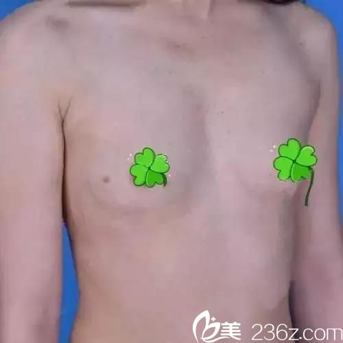 吴世元做硅胶假体隆胸术前效果 吴世元做硅胶假体隆胸术前效果