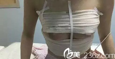 韩国吴世元整形外科医院吴世元做硅胶假体隆胸案例 韩国吴世元整形外科医院吴世元做硅胶假体隆胸案例