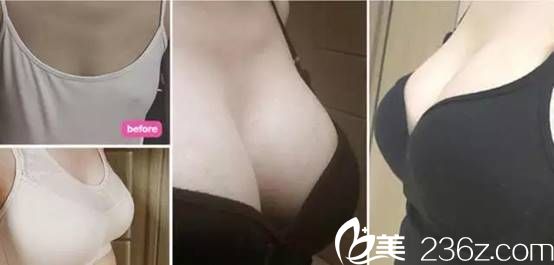 韩国吴世元整形外科医院吴世元做硅胶假体隆胸图 韩国吴世元整形外科医院吴世元做硅胶假体隆胸图