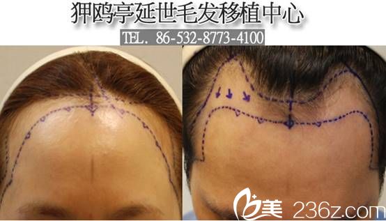 韩国狎鸥亭延世医院毛发移植发际线移植 韩国狎鸥亭延世医院毛发移植发际线移植