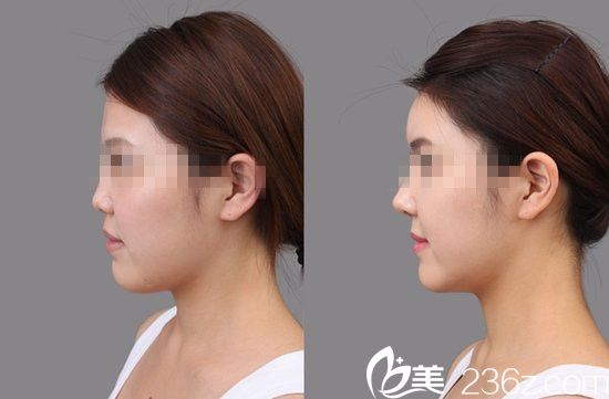 金基出院长隆鼻前后对比图 金基出院长隆鼻前后对比图
