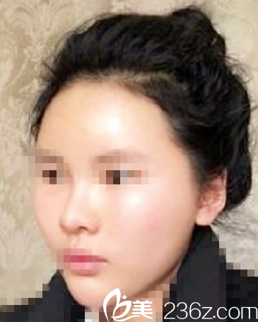 延世plus医院自体脂肪填充面部术后第三天