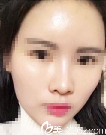 术后一周自体脂肪填充全脸