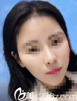 韩国延世Plus整形外科医院徐东皖院长做自体脂肪填充面部怎么样？真人案例