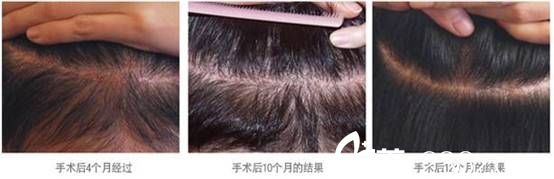 韩国狎鸥亭延世医院毛发移植术后效果图 韩国狎鸥亭延世医院毛发移植术后效果图