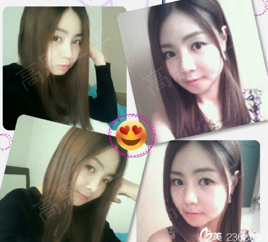 韩国高恩世上整形外科双眼皮真人<span style= 韩国高恩世上整形外科双眼皮真人<span style=