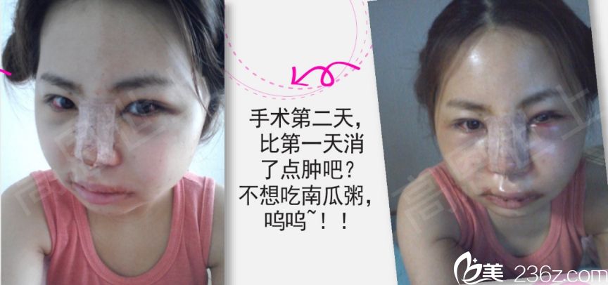 韩国高恩世上整形外科双眼皮真人<span style= 韩国高恩世上整形外科双眼皮真人<span style=