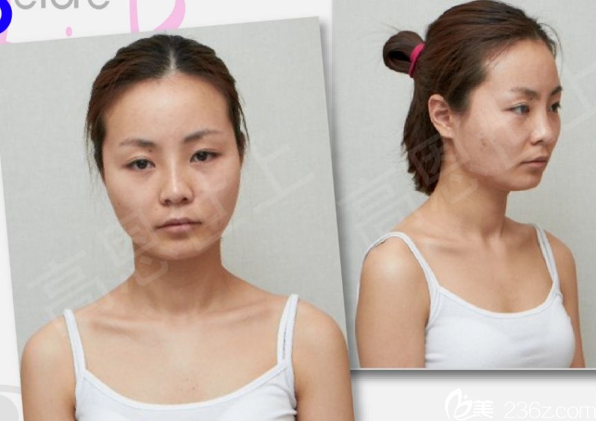 韩国高恩世上赵胄元院长 做眼睛出名吗?双眼皮+面部轮廓真人<span style= 韩国高恩世上赵胄元院长 做眼睛出名吗?双眼皮+面部轮廓真人<span style=