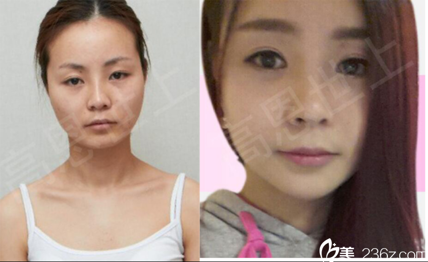 双眼皮 面部轮廓前后对比 双眼皮 面部轮廓前后对比