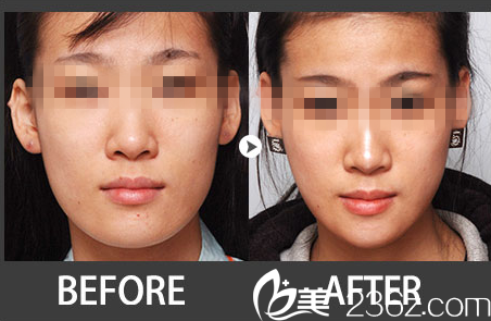 林平珍院长下颚整形真人案例