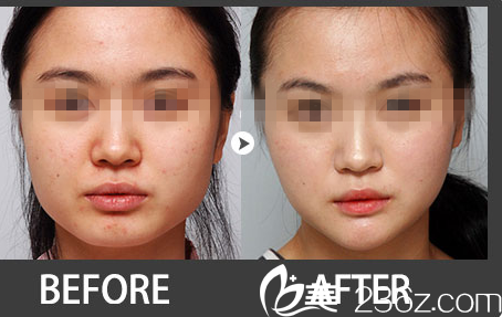 林平珍下颚整形前后