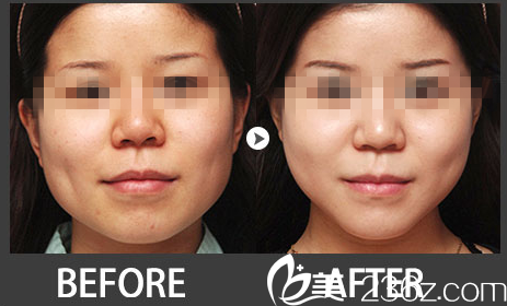 韩国妩丽整形外科下颚整形对比图