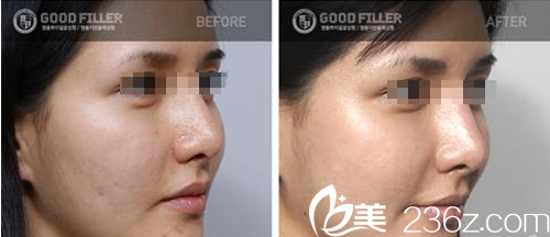 GOOD FILLER整形外科案例 GOOD FILLER整形外科案例